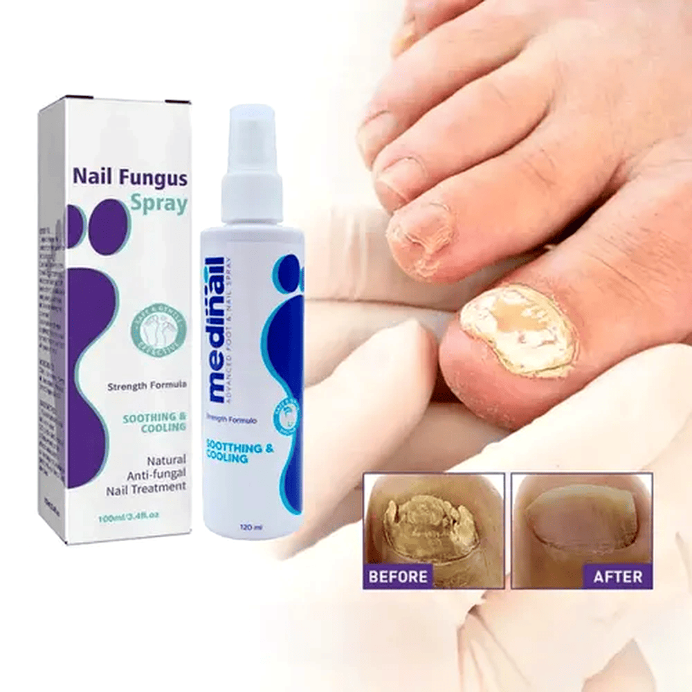 MEDINAIL-Spray Para los Hongos